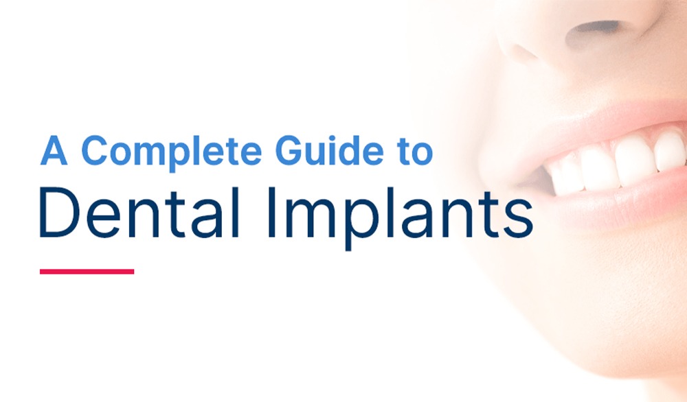 A Complete Guide to Dental Implants - Advanced Dental Implant Research   Education Center