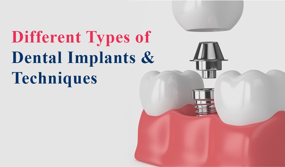 tooth implant types
